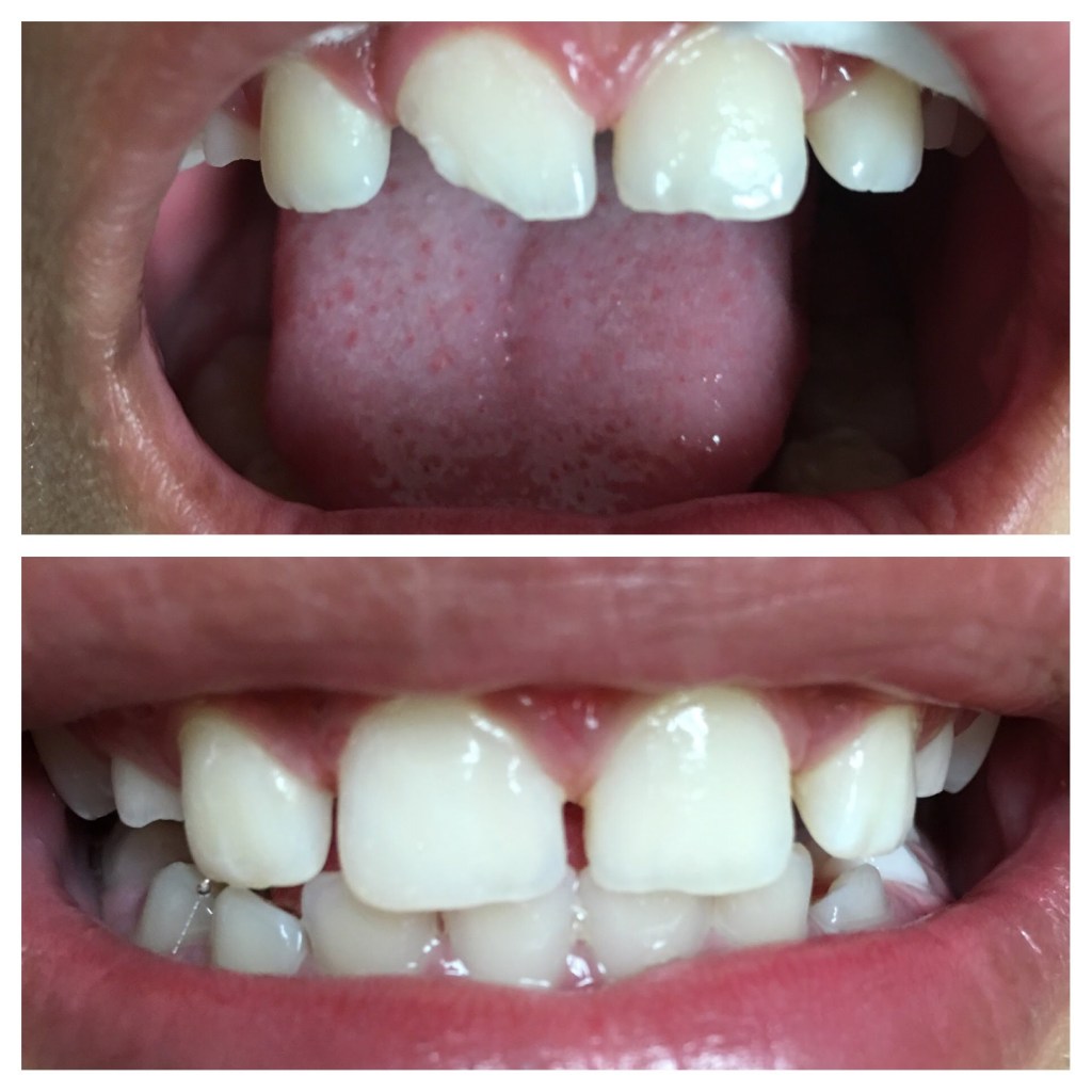 efore and after restoration of a missing upper central incisor: the 