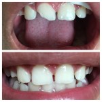 efore and after restoration of a missing upper central incisor: the 