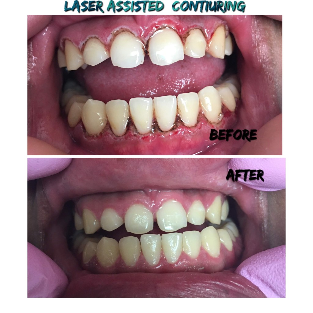 Before: Uneven, irregular gingival contours with excess tissue (gingival hyperplasia) covering tooth margins. After: Smooth, symmetrical gum line achieved via laser-assisted gingivectomy — improved tooth display and esthetics.