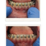 Before-and-after orthodontic treatment: upper and lower teeth with traditional metal braces; top image shows initial alignment phase, bottom image shows progressed tooth movement with improved spacing and occlusion