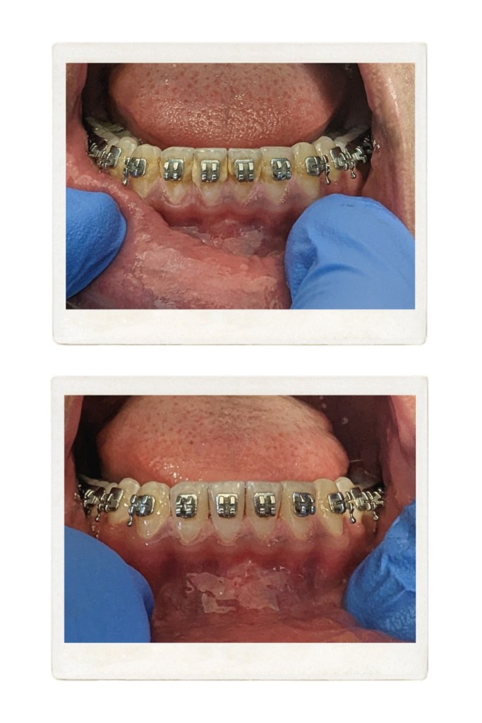 Before-and-after orthodontic treatment: upper and lower teeth with traditional metal braces; top image shows initial alignment phase, bottom image shows progressed tooth movement with improved spacing and occlusion